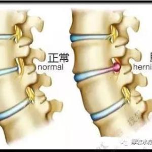 腰突症治疗