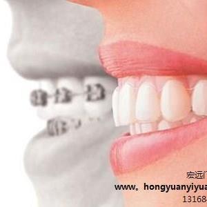 社區(qū)門診東莞口腔門診在線咨詢宏遠(yuǎn)門診部“口腔護(hù)理——正畸案例|”